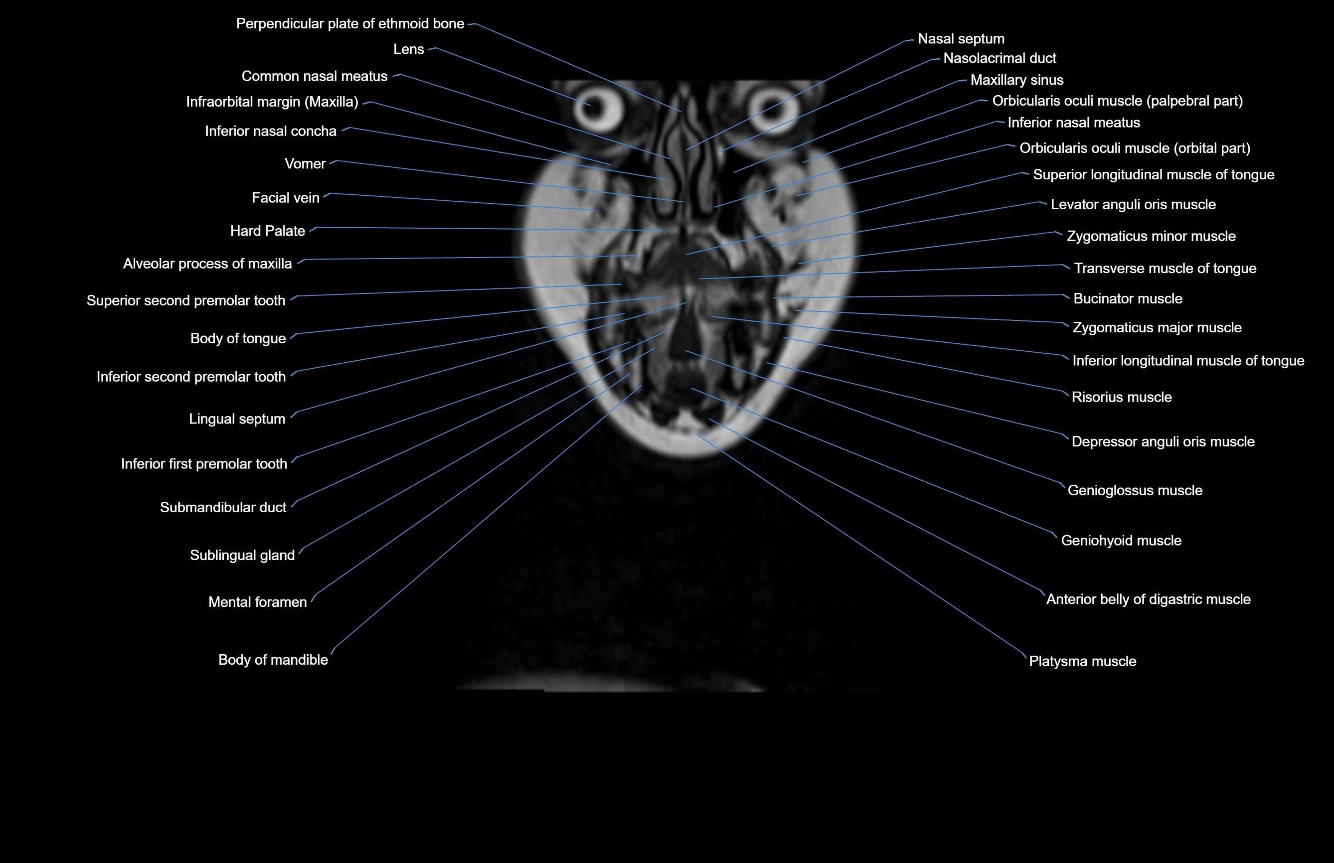 Neck coronal cross sectional MRI anatomy 3T MRI  image-img-00001-00069.webp